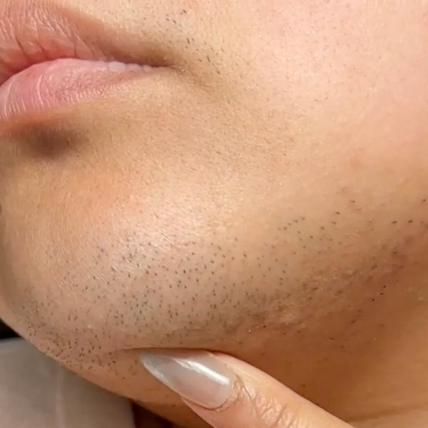 Hypertrichosis (Excess Hair Everywhere) vs Hirsutism (Hormone-Driven Hair)